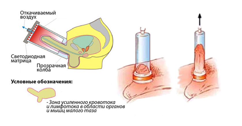 tratament antibiotic infectie urinara barbati dificil de tratat prostatita