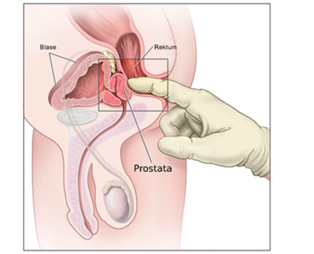 excreția de urină după urinare la bărbați microclistă prostatita